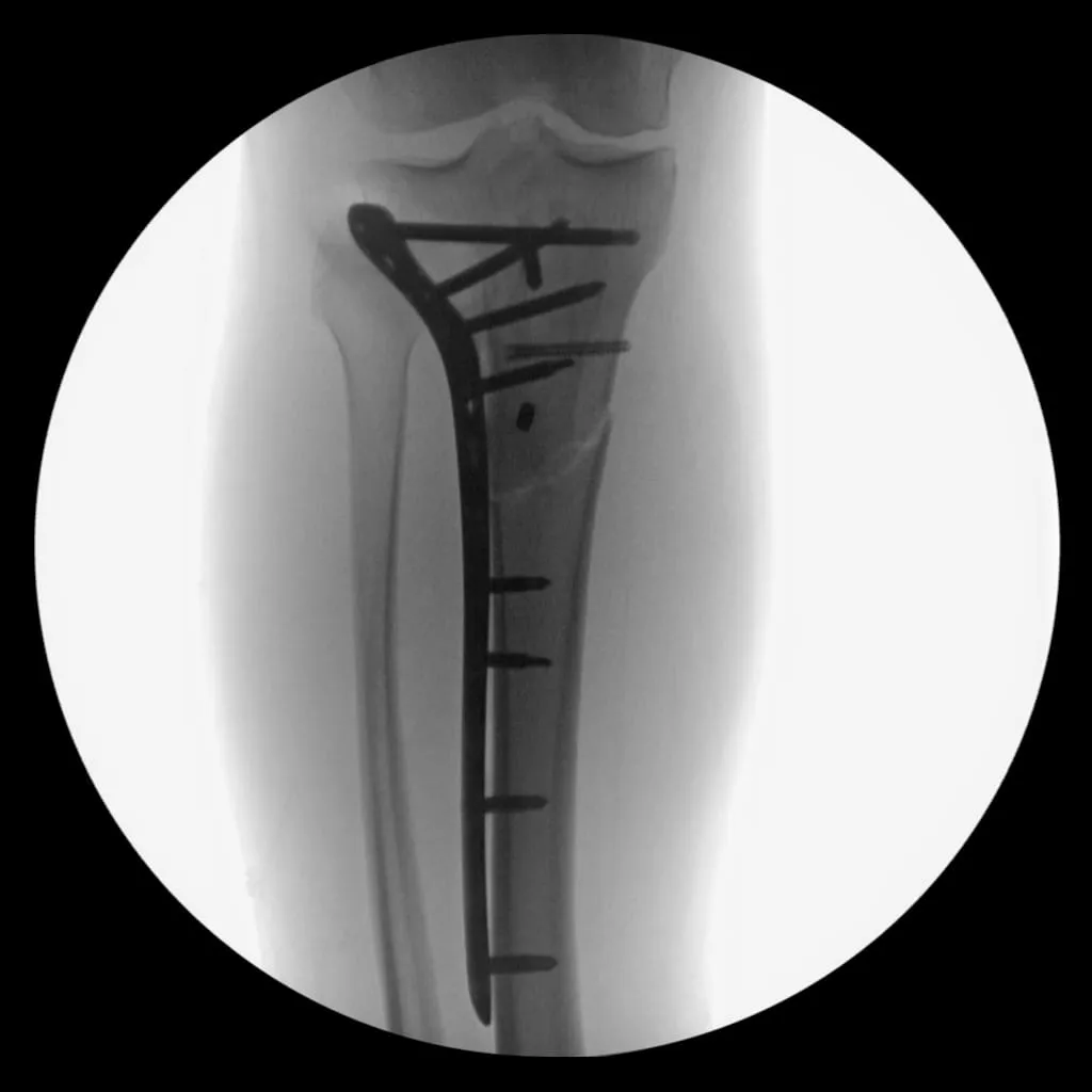 X-ray showing the titanium rod and screws in my right leg